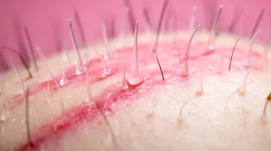 Dettaglio macro di cuoio capelluto sano con follicoli piliferi attivi e circolazione sanguigna visibile